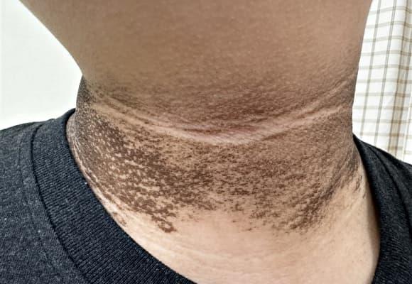 ung thư, dấu hiệu ᴜng thư, 5 bộ phận thȃm ᵭen phát hiện ᴜng thư