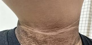 Nếu trong người có ung thư, 5 bộ phận này sẽ chuyển sang màu đen, tiếc rằng ít ai để ý!