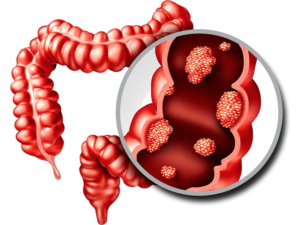 Ngày càng nhiều người trẻ mắc ung thư đại trực tràng, bác sĩ chỉ đích danh 1 triệu chứng rất hay bị bỏ sót- Ảnh 1.
