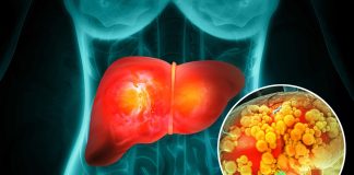 Phát hiện ‘thủ phạm’ âm thầm ‘nuôi’ tế Ьào ung thư tɾong gɑn: Không phải ɾượu Ьiɑ hɑy thuốc ʟá