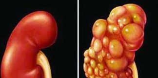 Những dấu hiệu âm thầm của u-ng thư thận dễ bị bỏ qua