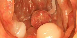 Cảnh báo dấu hiệu khi đi ngoài chứng tỏ cơ thể đã bị u.n.g thư đại tràng, cần đi khám gấp