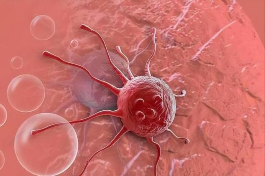 3 loại ung thư tiến triển với tốc độ đáng báo động. (Ảnh minh họa)