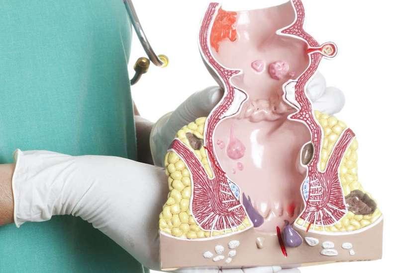 Không biết cách vệ sinh hậu môn có thể dẫn đến những bệnh lý nghiêm trọng vùng hậu môn - trực tràng