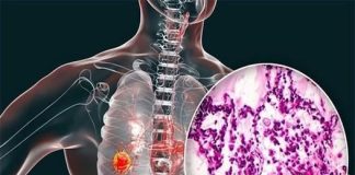 Cảnh báo ungthư phổi gia tăng: Bác sĩ khuyên tránh 4 loại thực phẩm để lâu trong tủ lạnh
