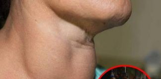 Số lượng u tuyến giáp ngày càng tăng nhanh, bác sĩ khuyên nên ăn ít hơn loại thực phẩm