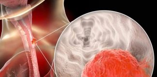 UT thực quản trẻ hóa, bác sĩ cảnh báo ‘nóng’